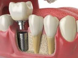 Tooth Extraction and Dental&nbsp;Implant